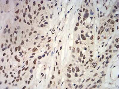 Immunohistochemistry: Apc10 Antibody (8F1D10) [NBP2-61889] - Analysis of paraffin-embedded esophageal cancer tissues using ANAPC10 mouse mAb with DAB staining.