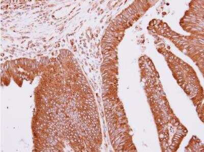 Immunohistochemistry-Paraffin: Apc10 Antibody [NBP2-15423] - Paraffin-embedded colon carcinoma. Apc10 antibody [N1C3] dilution: 1:500.