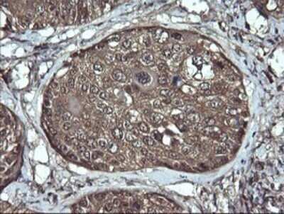 Immunohistochemistry: Apc11 Antibody (OTI3F5) - Azide and BSA Free [NBP2-71939] - Analysis of Carcinoma of Human lung tissue. (Heat-induced epitope retrieval by 10mM citric buffer, pH6.0, 120C for 3min)