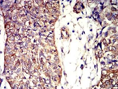 Immunohistochemistry: Apc2 Antibody (3A2G2) [NBP2-61656] - Analysis of paraffin-embedded bladder cancer tissues using APC2 mouse mAb with DAB staining.