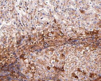 Immunohistochemistry-Paraffin: Apolipoprotein A-II/ApoA2 Antibody (JB70-35) [NBP2-75410] - Analysis of paraffin-embedded human liver tissue with Rabbit anti-Apolipoprotein A-II/ApoA2 antibody washed with ddH2O and PBS, and then probed with the primary antibody  at 1/400 dilution for 1 hour at room temperature. The detection was performed using an HRP conjugated compact polymer system. DAB was used as the chromogen. Tissues were counterstained with hematoxylin and mounted with DPX.