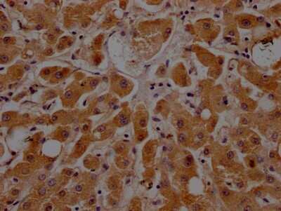 Immunohistochemistry: Apolipoprotein CIII Antibody (8H12) [NBP3-15194] - IHC image of Apolipoprotein CIII antibody diluted at 1:100 and staining in paraffin-embedded human liver tissue. After dewaxing and hydration, antigen retrieval was mediated by high pressure in a citrate buffer (pH 6.0). Section was blocked with 10% normal goat serum 30 minutes at RT. Then primary antibody (1% BSA) was incubated at 4C overnight. The primary is detected by a Goat anti-rabbit IgG polymer labeled by HRP and visualized using 0.05% DAB.