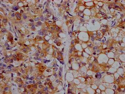 Immunohistochemistry: Apolipoprotein CIII Antibody (8H12) [NBP3-15194] - IHC image of Apolipoprotein CIII antibody diluted at 1:100 and staining in paraffin-embedded human liver cancer. After dewaxing and hydration, antigen retrieval was mediated by high pressure in a citrate buffer (pH 6.0). Section was blocked with 10% normal goat serum 30 minutes at RT. Then primary antibody (1% BSA) was incubated at 4C overnight. The primary is detected by a Goat anti-rabbit IgG polymer labeled by HRP and visualized using 0.05% DAB.