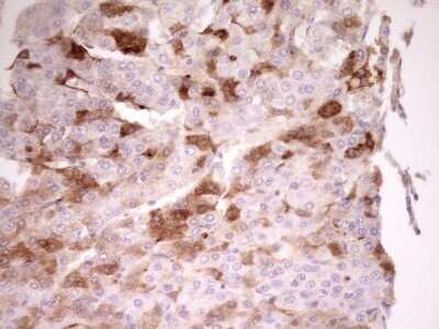 Immunohistochemistry: Apolipoprotein H/ApoH Antibody (OTI4A11) - Azide and BSA Free [NBP2-70186] - Analysis of Carcinoma of Human liver tissue. (Heat-induced epitope retrieval by 1 mM EDTA in 10mM Tris, pH8.5, 120C for 3min)