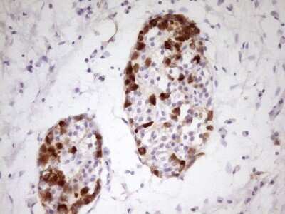 Immunohistochemistry: Apolipoprotein H/ApoH Antibody (OTI4A11) - Azide and BSA Free [NBP2-70186] - Analysis of Carcinoma of Human pancreas tissue. (Heat-induced epitope retrieval by 1 mM EDTA in 10mM Tris, pH8.5, 120C for 3min)