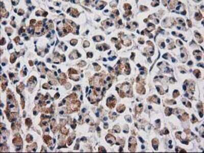 Immunohistochemistry: Aquaporin 1/AQP1 Antibody (OTI2D10) - Azide and BSA Free [NBP2-70199] - Staining of paraffin-embedded Adenocarcinoma of Human colon tissue using anti-Aquaporin-1 mouse monoclonal antibody.