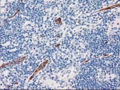 Immunohistochemistry: Aquaporin 1/AQP1 Antibody (OTI2D10) - Azide and BSA Free [NBP2-70199] - Staining of paraffin-embedded Human lymphoma tissue using anti-Aquaporin-1 mouse monoclonal antibody.