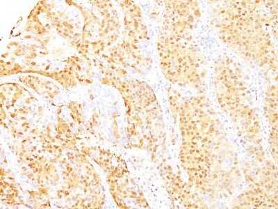 Immunohistochemistry-Paraffin: Arginase 1/ARG1/liver Arginase Antibody (ARG1/1125 + ARG1/1126) - Azide and BSA Free [NBP2-48000] - Formalin-fixed, paraffin-embedded human Hepatocellular Carcinoma stained with Arginase 1/ARG1/liver Arginase Antibody (ARG1/1125 + ARG1/1126).