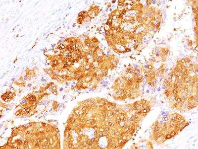 Immunohistochemistry-Paraffin: Arginase 1/ARG1/liver Arginase Antibody (ARG1/1125 + ARG1/1126) - IHC-Prediluted [NBP2-48255] - Formalin-fixed, paraffin-embedded human Hepatocellular Carcinoma stained with ARG1 Mouse Monoclonal Antibody (ARG1/1125 + ARG1/1126).
