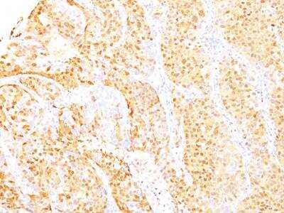 Immunohistochemistry-Paraffin: Arginase 1/ARG1/liver Arginase Antibody (ARG1/1125 + ARG1/1126) - IHC-Prediluted [NBP2-48255] - Formalin-fixed, paraffin-embedded human Hepatocellular Carcinoma stained with ARG1 Mouse Monoclonal Antibody (ARG1/1125 + ARG1/1126).