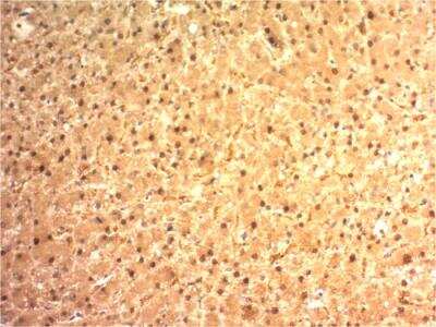 Immunohistochemistry-Paraffin: Arginase 1/ARG1/liver Arginase Antibody (ARG1/1125) - IHC-Prediluted [NBP2-48229] - Formalin-fixed, paraffin-embedded human Hepatocellular Carcinoma stained with ARG1 Mouse Monoclonal Antibody (ARG1/1125).