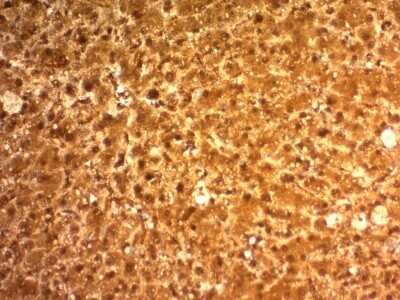 Immunohistochemistry-Paraffin: Arginase 1/ARG1/liver Arginase Antibody (ARG1/1126) - Azide and BSA Free [NBP2-47999] - Human Hepatocellular Carcinoma stained with ARG1 Monoclonal Antibody (ARG1/1126).