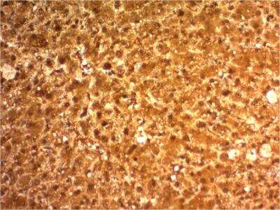 Immunohistochemistry-Paraffin: Arginase 1/ARG1/liver Arginase Antibody (ARG1/1126) - IHC-Prediluted [NBP2-48230] - Formalin-fixed, paraffin-embedded human Hepatocellular Carcinoma stained with ARG1-Monospecific Mouse Monoclonal Antibody (ARG1/1126).
