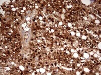 Immunohistochemistry: Argininosuccinate Lyase Antibody (OTI3D4) - Azide and BSA Free [NBP2-70213] - Analysis of Carcinoma of Human liver tissue.