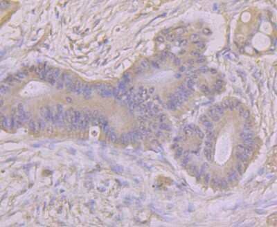 Immunohistochemistry-Paraffin: Argininosuccinate Synthase Antibody (11F1) [NBP2-76941] - Analysis of human colon cancer tissue using anti-ASS1 antibody. Counter stained with hematoxylin.