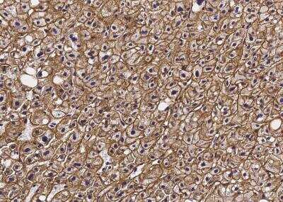 Immunohistochemistry-Paraffin: Asialoglycoprotein Receptor 2 Antibody (002) [NBP3-06211] - Staining of human ASGR2 in human cirrhosis with rabbit monoclonal antibody (1:200).