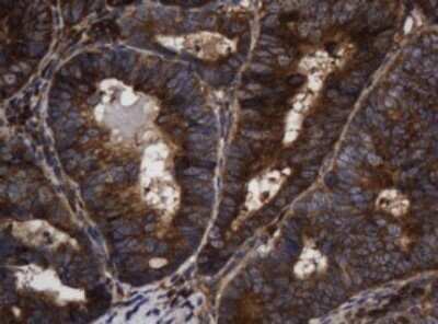 Immunohistochemistry: Asialoglycoprotein Receptor 2 Antibody (OTI2A12) - Azide and BSA Free [NBP2-70212] - Analysis of Adenocarcinoma of Human colon tissue. Heat-induced epitope retrieval by 10 mM citric buffer, pH 6.0, 120C for 3 minutes.