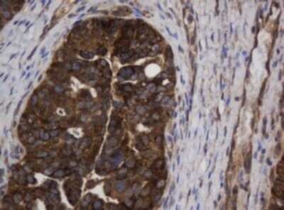 Immunohistochemistry: Asialoglycoprotein Receptor 2 Antibody (OTI2A12) - Azide and BSA Free [NBP2-70212] - Analysis of Adenocarcinoma of Human ovary tissue. Heat-induced epitope retrieval by 10 mM citric buffer, pH 6.0, 120C for 3 minutes.