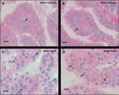 Immunohistochemistry: B-Raf Antibody (OTI5A9) - Azide and BSA Free [NBP2-70260] - The images depict immunostaining of representative PTC cases harboring BRAF wild-type (A, B) and BRAF V600E mutation (C, D) proven by NGS; varying degrees of immunoreactivity for BRAF is shown both in the intranuclear inclusions (arrows) and in the cytopl