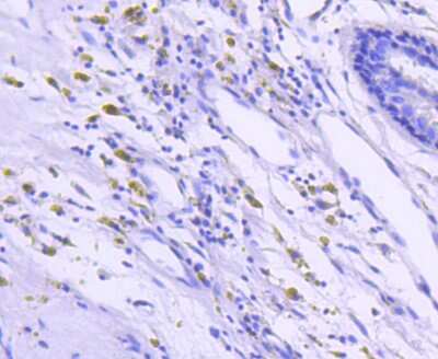 Immunohistochemistry-Paraffin: B-Raf Antibody (SU34-04) [NBP2-67469] - Analysis of paraffin-embedded human breast carcinoma tissue using anti-B Raf antibody. Counter stained with hematoxylin.