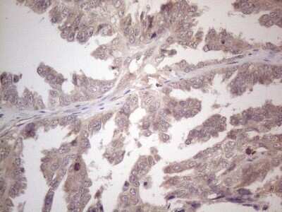 Immunohistochemistry: B4GALT4 Antibody (8B6) [NBP2-46562] - Analysis of Adenocarcinoma of Human ovary tissue. (Heat-induced epitope retrieval by 1mM EDTA in 10mM Tris buffer (pH8.5) at 120C for 3 min)