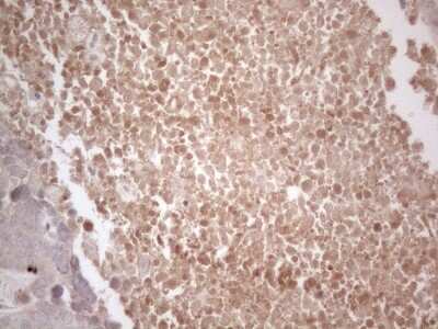 Immunohistochemistry: B4GALT4 Antibody (8B6) [NBP2-46562] - Analysis of Adenocarcinoma of Human endometrium tissue. (Heat-induced epitope retrieval by 1mM EDTA in 10mM Tris buffer (pH8.5) at 120C for 3 min)