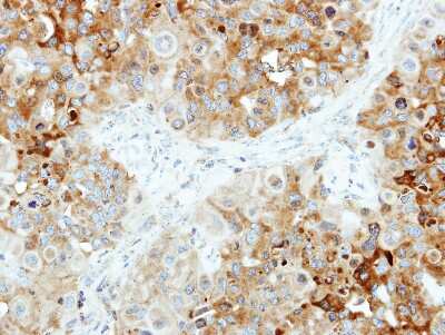 Immunohistochemistry-Paraffin: B4GALT4 Antibody [NBP2-15534] - Immunohistochemical analysis of paraffin-embedded H441 xenograft, using antibody at 1:250 dilution.