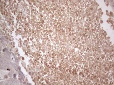 Immunohistochemistry: B4GALT4 Antibody (OTI8B6) - Azide and BSA Free [NBP2-71385] - Analysis of Adenocarcinoma of Human endometrium tissue. (Heat-induced epitope retrieval by 1mM EDTA in 10mM Tris buffer (pH8.5) at 120C for 3 min)