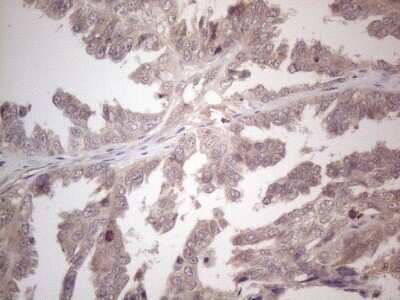 Immunohistochemistry: B4GALT4 Antibody (OTI8B6) - Azide and BSA Free [NBP2-71385] - Analysis of Adenocarcinoma of Human ovary tissue. (Heat-induced epitope retrieval by 1mM EDTA in 10mM Tris buffer (pH8.5) at 120C for 3 min)