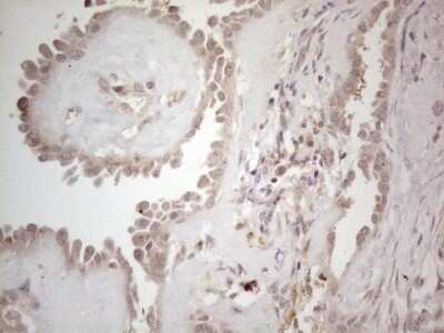 Immunohistochemistry: B4GALT4 Antibody (OTI8B6) - Azide and BSA Free [NBP2-71385] - Analysis of Carcinoma of Human thyroid tissue. (Heat-induced epitope retrieval by 1mM EDTA in 10mM Tris buffer (pH8.5) at 120C for 3 min)