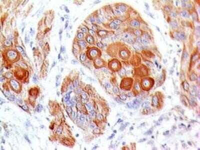 Immunohistochemistry-Paraffin: B7-2/CD86 Antibody (BU63) - IHC-Prediluted [NBP2-44513] - Formalin-fixed, paraffin-embedded esophagus tumor tissue stained with CD86 antibody (5 ug/ml), peroxidase-conjugate and DAB chromogen. Note strong staining of differentiated squamous cells. TMA was used for this test.