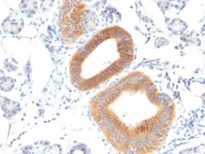 Immunohistochemistry-Paraffin: B7-2/CD86 Antibody (C86/1146) - Azide and BSA Free [NBP2-47778] - Human Melanoma stained with CD86 Monoclonal Antibody (C86/1146).