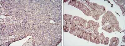 Immunohistochemistry-Paraffin: B7-H3/CD276 Antibody (6A1) [NBP2-37657] - Analysis of cervical cancer tissues (left) and ovarian cancer tissues (right) using CD276 mouse mAb with DAB staining.