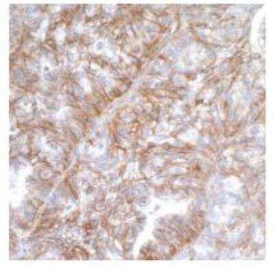 Immunohistochemistry-Paraffin: B7-H3/CD276 Antibody (BLR025F) [NBP3-14669] - Section of ovarian carcinoma. Antibody: Rabbit anti-B7-H3/CD276 recombinant monoclonal antibody used at 1:200. Secondary: HRP-conjugated goat antirabbit IgG (A120-501P). Substrate: DAB.