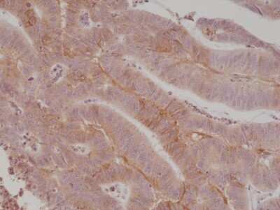 Immunohistochemistry-Paraffin: B7-H3/CD276 Antibody (RM335) [NBP2-77415] - Staining of human colon cancer tissue section using NBP2-77415.