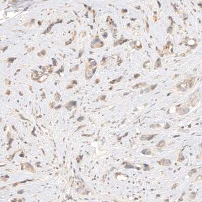 Immunohistochemistry-Paraffin: B7-H6 Antibody [NBP1-91144] - Staining of human breast cancer shows weak cytoplasmic positivity in tumor cells.