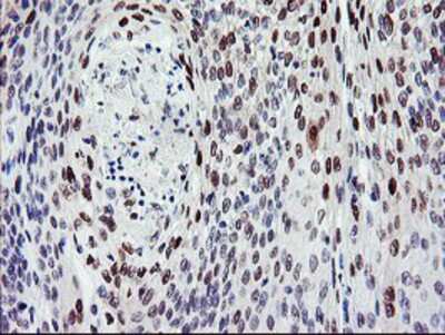 Immunohistochemistry-Paraffin: BACH1 Antibody (4E11) [NBP2-01904] - Staining of paraffin-embedded Carcinoma of Human bladder tissue using anti-BACH1 mouse monoclonal antibody.