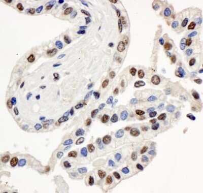 Immunohistochemistry: BAF57 Antibody [NB100-2591] - Sample: FFPE section of human prostate carcinoma. Antibody: Affinity purified rabbit anti- BAF57/SMARCE1 used at a dilution of 1:1,000 (1ug/ml). Detection: DAB