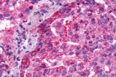 Immunohistochemistry-Paraffin: BAI1 Antibody [NLS989] - Anti-BAI1 antibody IHC of human Lung, Adenocarcinoma. Immunohistochemistry of formalin-fixed, paraffin-embedded tissue after heat-induced antigen retrieval.