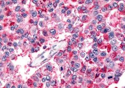 Immunohistochemistry-Paraffin: BAI2 Antibody [NLS981] - Human Lung, Non-Small Cell Carcinoma. Immunohistochemistry of formalin-fixed, paraffin-embedded tissue after heat-induced antigen retrieval.