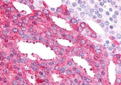 Immunohistochemistry-Paraffin: BAI2 Antibody [NLS981] - Human Prostate, Carcinoma. Immunohistochemistry of formalin-fixed, paraffin-embedded tissue after heat-induced antigen retrieval.