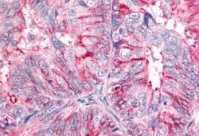 Immunohistochemistry-Paraffin: BAI2 Antibody [NLS982] - Anti-BAI2 antibody IHC of human Ovary, Carcinoma. Immunohistochemistry of formalin-fixed, paraffin-embedded tissue after heat-induced antigen retrieval.
