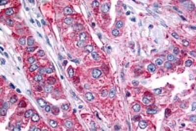 Immunohistochemistry-Paraffin: BAI2 Antibody [NLS984] - Anti-BAI2 antibody IHC of human Lung, Non-Small Cell Carcinoma. Immunohistochemistry of formalin-fixed, paraffin-embedded tissue after heat-induced antigen retrieval.