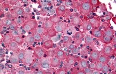 Immunohistochemistry-Paraffin: BAI2 Antibody [NLS984] - Anti-BAI2 antibody IHC of human Skin, Melanoma. Immunohistochemistry of formalin-fixed, paraffin-embedded tissue after heat-induced antigen retrieval.