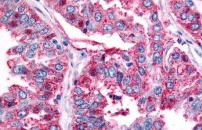 Immunohistochemistry-Paraffin: BAI2 Antibody [NLS984] - Lung, non small cell carcinoma