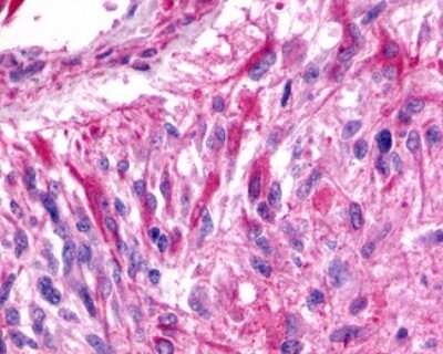 Immunohistochemistry-Paraffin: BAI3 Antibody [NLS978] - Analysis of anti-BAI3 antibody with human brain, glioblastoma.