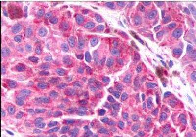 Immunohistochemistry-Paraffin: BAI3 Antibody [NLS978] - Human Skin, Melanoma. Immunohistochemistry of formalin-fixed, paraffin-embedded tissue after heat-induced antigen retrieval.