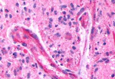 Immunohistochemistry-Paraffin: BAI3 Antibody [NLS978] - Brain, glioblastoma and vessels