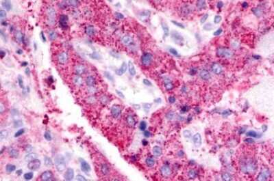 Immunohistochemistry-Paraffin: BAI3 Antibody [NLS979] - Human Lung, Adenocarcinoma after heat-induced antigen retrieval.