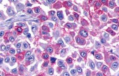 Immunohistochemistry-Paraffin: BAI3 Antibody [NLS979] - Human Skin, Melanoma tissue after heat-induced antigen retrieval.